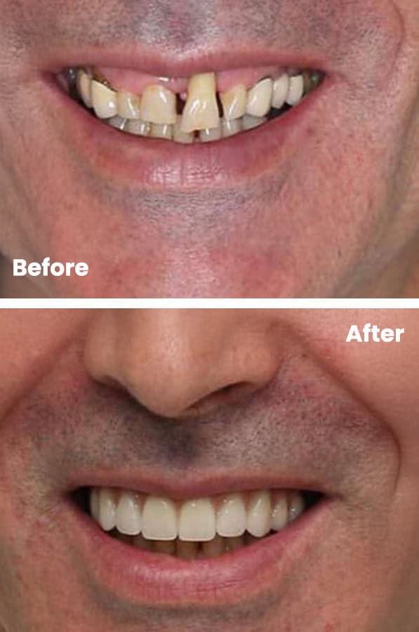 Full-mouth restoration planning